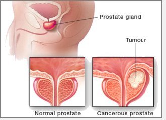 Prostate Cancer Frequently Asked Questions